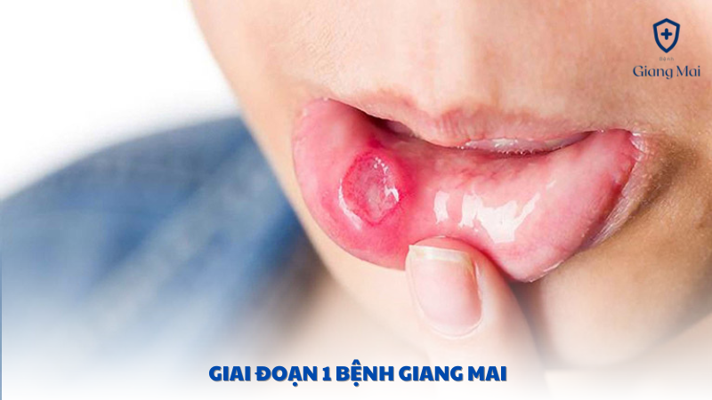 giai đoạn 1 bệnh giang mai