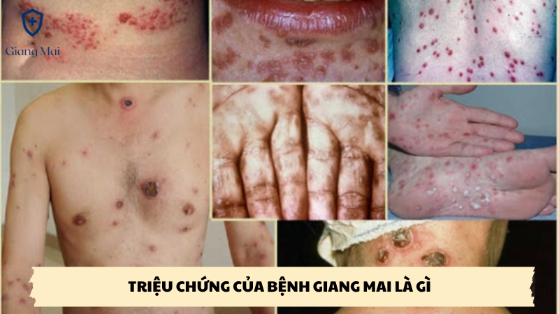 triệu chứng của bệnh giang mai là gì