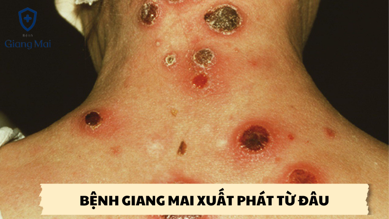 bệnh giang mai xuất phát từ đâu