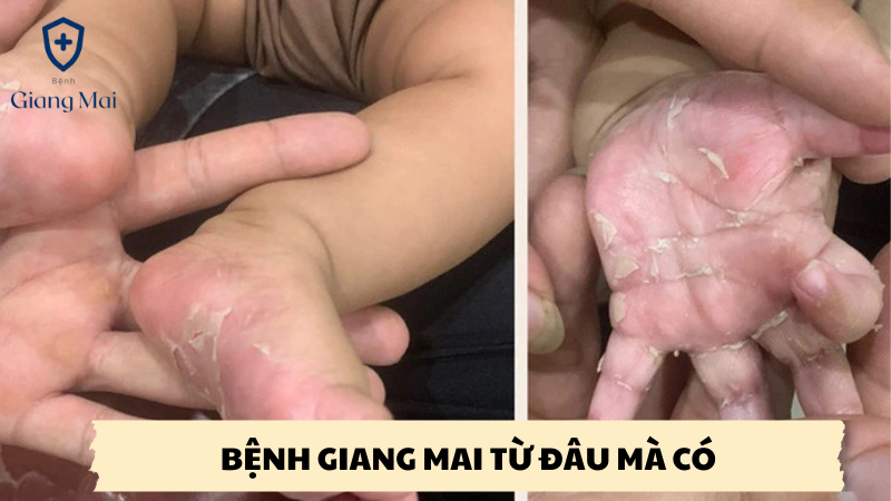 Bệnh giang mai từ đâu mà có